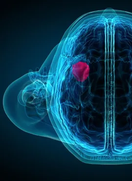 Cirugía de Tumor Cerebral en Villahermosa