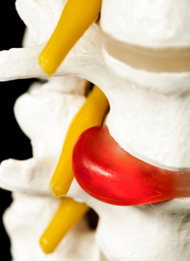 cura de hernia discal Cirugía de hernia discal en Villahermosa
