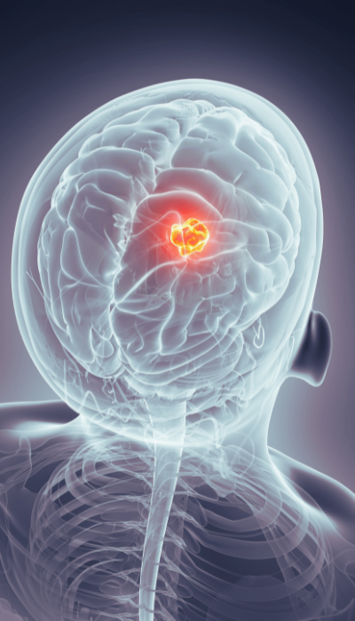 Especialista en Aneurisma Cerebral en Villahermosa