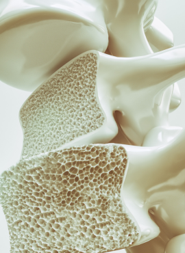 Cifoplastia en Villahermosa
