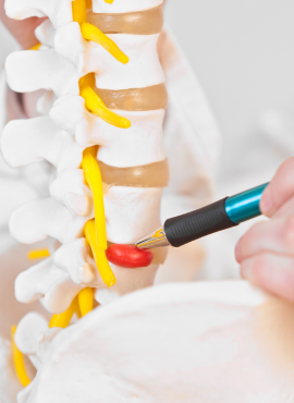 sintomas de hernia discal Cirugía de hernia discal en Villahermosa